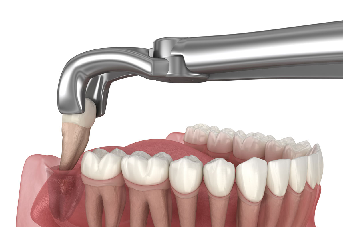 Tooth Extractions